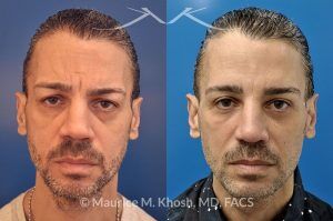 Photo of a patient before and after a procedure. Repair of nose fracture - before and after results.