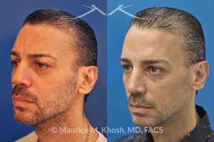 Photo of a patient before and after a procedure. Repair of nose fracture - before and after results.