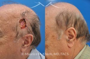 Photo of a patient before and after a procedure. Mohs' repair of scalp - before and after results.