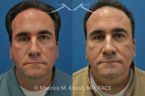 Photo of a patient before and after a procedure. Right eye socket fracture repaired with bone graft - before and after results.