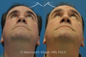 Photo of a patient before and after a procedure. Right eye socket fracture repaired with bone graft - before and after results.