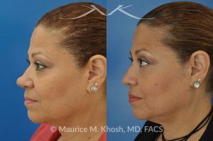 Photo of a patient before and after a procedure. Removal of skin cancer in the tip of the nose with repair - before and after photos.