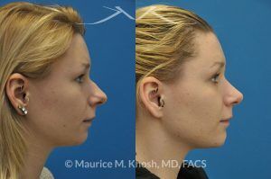Photo of a patient before and after a procedure. Rhinoplasty and chin implant - before and after photo.