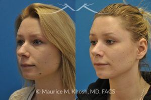 Photo of a patient before and after a procedure. Rhinoplasty and chin implant - before and after photo.