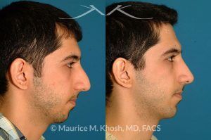 Photo of a patient before and after a procedure. Rhinoplasty and chin implant - before and after photo.