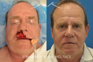 Photo of a patient before and after a procedure. Lip reconstruction for Mohs skin cancer defect - before and after photos.