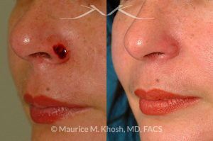 Photo of a patient before and after a procedure. Moh's skin cancer repair of nose - before and after photos.