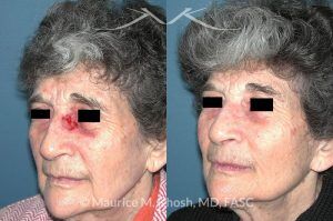 Photo of a patient before and after a procedure. Nose Moh's skin cancer repair - before and after photos.