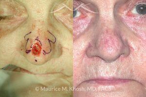 Photo of a patient before and after a procedure. Nose tip Moh's skin cancer reconstruction - before and after photos.