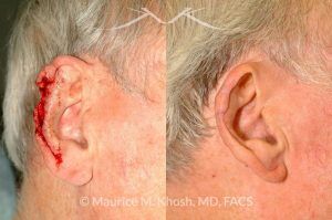 Photo of a patient before and after a procedure. Ear reconstruction after Mohs skin cancer removal - before and after results.