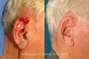 Photo of a patient before and after a procedure. Mohs defect repair of ear - before and after results.