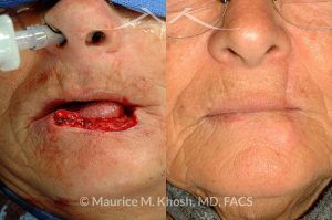 Photo of a patient before and after a procedure. Lip reconstruciton with Abbe Estelander flap - before and after results.