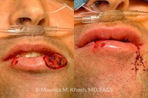 Photo of a patient before and after a procedure. Lip reconstruction - before and after results.