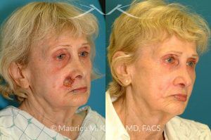 Photo of a patient before and after a procedure. Lip reconstruction for Mohs skin cancer defect - before and after results.