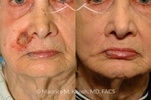 Photo of a patient before and after a procedure. Lip reconstruction for Mohs skin cancer defect - before and after results.