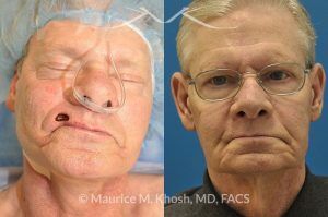 Photo of a patient before and after a procedure. Lip reconstructiton - before and after results.