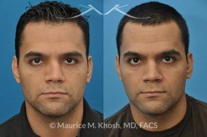 Photo of a patient before and after a procedure. Nose Fracture - before and after results.