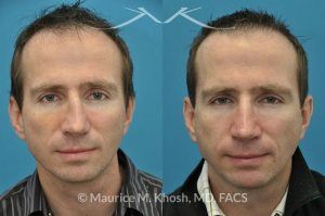 Photo of a patient before and after a procedure. Nose Fracture - before and after results.