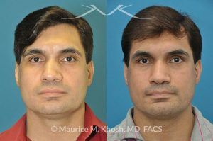 Photo of a patient before and after a procedure. Nose Fracture - before and after results.