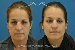 Photo of a patient before and after a procedure. Nose Fracture - before and after results.