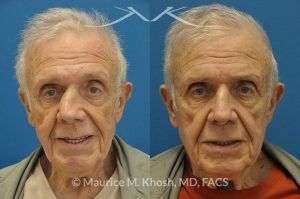 Photo of a patient before and after a procedure. Nose Fracture - before and after results.