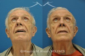 Photo of a patient before and after a procedure. Nose Fracture - before and after results.