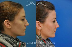 Photo of a patient before and after a procedure. Nose Fracture - before and after results.