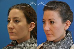 Photo of a patient before and after a procedure. Nose Fracture - before and after results.