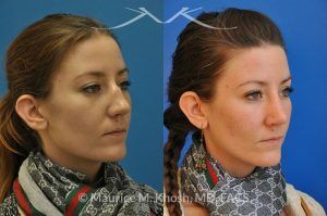 Photo of a patient before and after a procedure. Nose Fracture - before and after results.