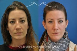 Photo of a patient before and after a procedure. Nose Fracture - before and after results.