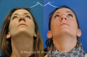 Photo of a patient before and after a procedure. Nose Fracture - before and after results.