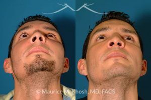 Photo of a patient before and after a procedure. Nose Fracture - before and after results.