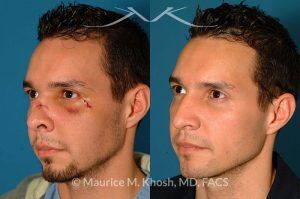 Photo of a patient before and after a procedure. Nose Fracture - before and after results.