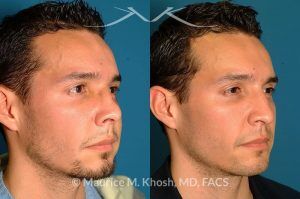 Photo of a patient before and after a procedure. Nose Fracture - before and after results.