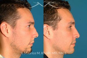 Photo of a patient before and after a procedure. Nose Fracture - before and after results.