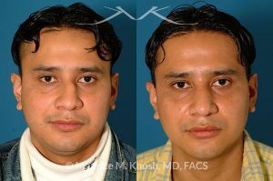 Photo of a patient before and after a procedure. Nose Fracture - before and after results.