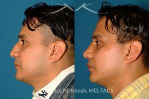 Photo of a patient before and after a procedure. Nose Fracture - before and after results.