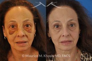 Photo of a patient before and after a procedure. Nose fracture repair - before and after results.