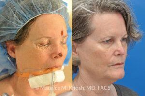 Photo of a patient before and after a procedure. Mohs reconstruction of forehead - before and after results.