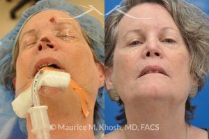 Photo of a patient before and after a procedure. Mohs reconstruction of forehead - before and after results.
