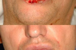 Photo of a patient before and after a procedure. Repair of 75% lower lip defect with Karapandzic flap - before and after photos.