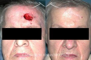 Photo of a patient before and after a procedure. Repair of left forehead defect - before and after photos.