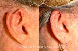 Photo of a patient before and after a procedure. Advancement flap repair of rim defect - before and after photos.