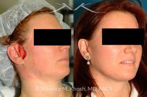 Photo of a patient before and after a procedure. Lateral cheek Mohs defect repaired with a facelift flap - before and after results.