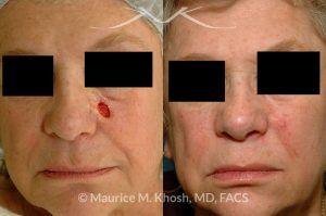 Photo of a patient before and after a procedure. Mohs defect of the medial cheek repaired with a local advancement flap - before and after results.
