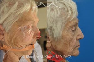 Photo of a patient before and after a procedure. Nose Moh's skin cancer repair, utilizing forehead flap and ear cartilage graft - before and after photos.