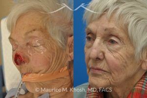 Photo of a patient before and after a procedure. Nose Moh's skin cancer repair, utilizing forehead flap and ear cartilage graft - before and after photos.