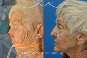 Photo of a patient before and after a procedure. Nose Moh's skin cancer repair, utilizing forehead flap and ear cartilage graft - before and after photos.