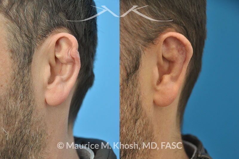 Cauliflower Ear Treatment New York, NY