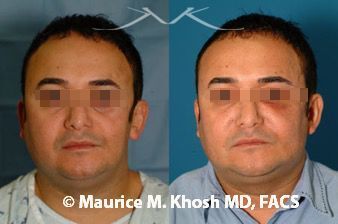 Cheek reconstruction New York, NY